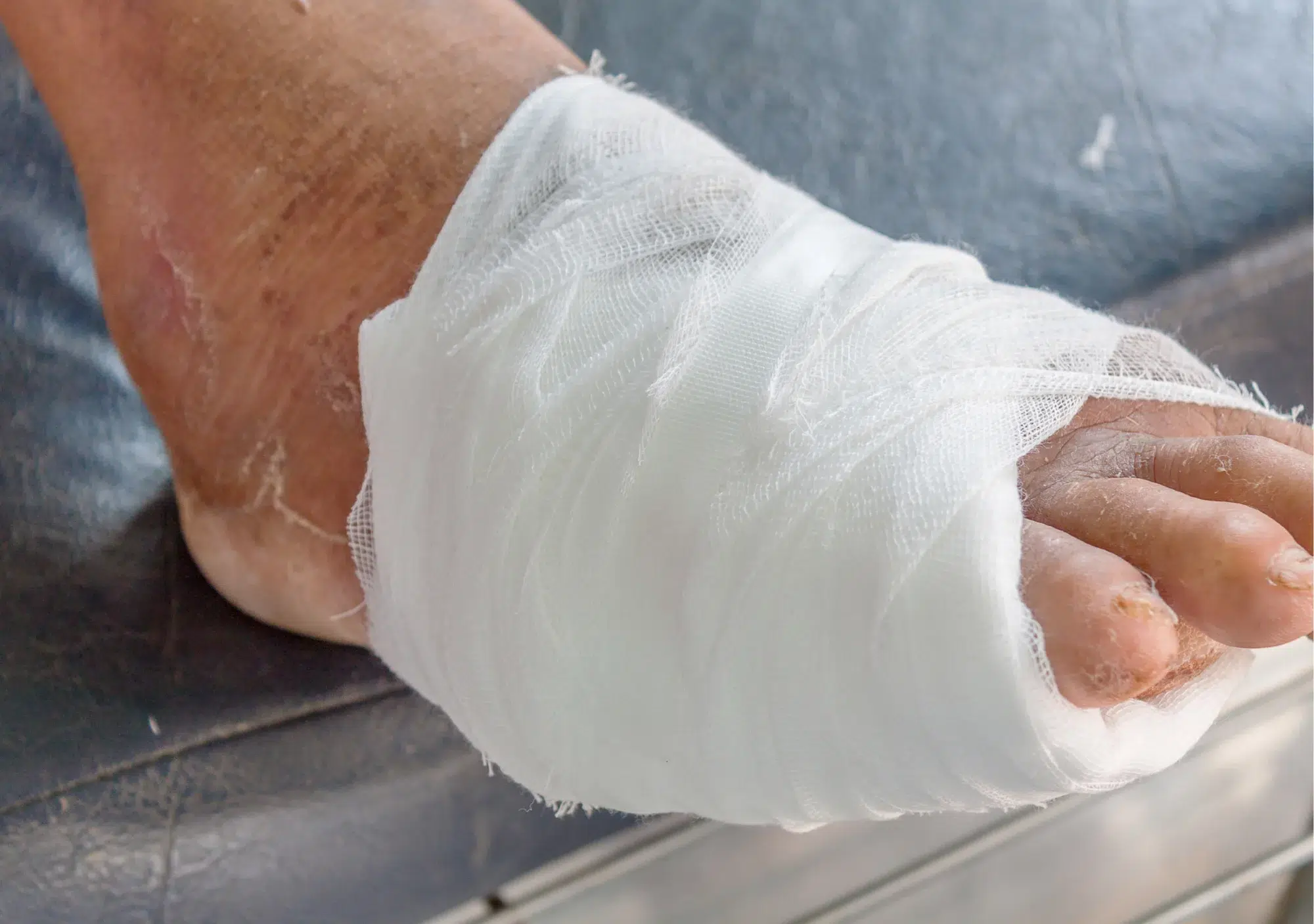 A foot which has been treated for diabetic foot and has a tape around it